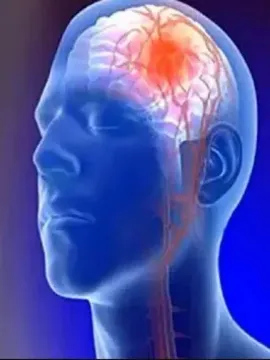 యువతలో పెరిగిపోతున్న స్ట్రోక్‌ ముప్పు
