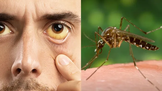 Yellow Fever:ఎల్లో ఫీవర్‌ అంటే ఏమిటి? ఈ జ్వరం లక్షణాలు, కారణాలు ఏంటో తెలుసుకోండి!