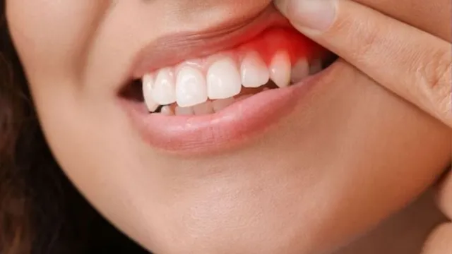 చిగురు వాపు సమస్యకు సింపుల్ హోం రెమిడీస్!