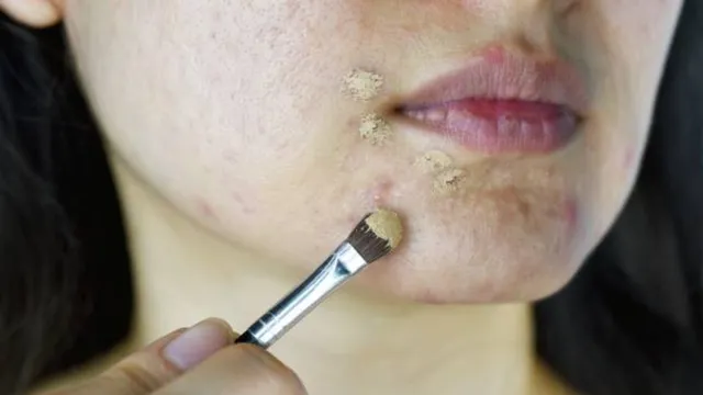 Pimples: మేకప్ తర్వాత మీ ముఖంపై మొటిమలు వస్తున్నాయా? ఇలా చేయండి!