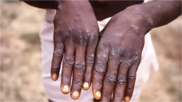 Sweden: స్వీడెన్‌లోనూ ఎంపాక్స్ వైరస్..మొదట కేసు నమోదు