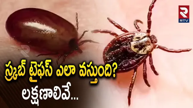 స్క్రబ్ టైఫస్ లక్షణాలివే... | Scrub Tyfus Causes And Symptoms | AP Scrub Tyfus Cases | RTV