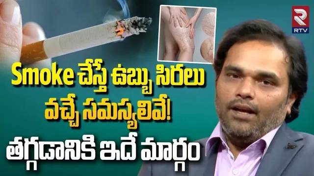 Dr Avinash About Varicose Veins Remedies | ఉబ్బు సిరలు తగ్గడానికి ఇదే మార్గం | Avis Hospital | RTV