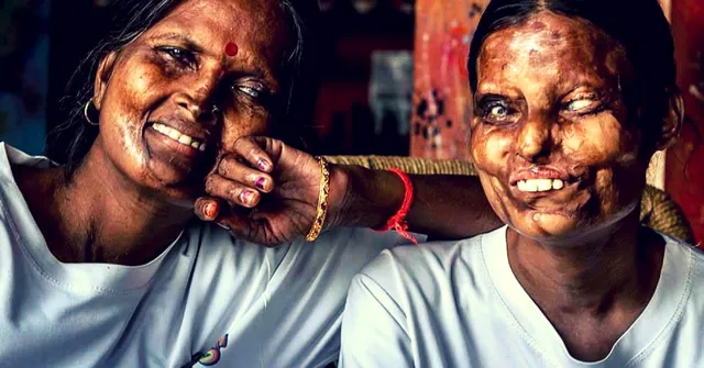 Acid Attack Survivors & Autistic Persons: A Change to India's Disability Act Will Help Even More People