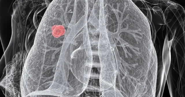 Back Pain May Be Linked to Lung Cancer? 6 Common Signs That You May Be at Risk