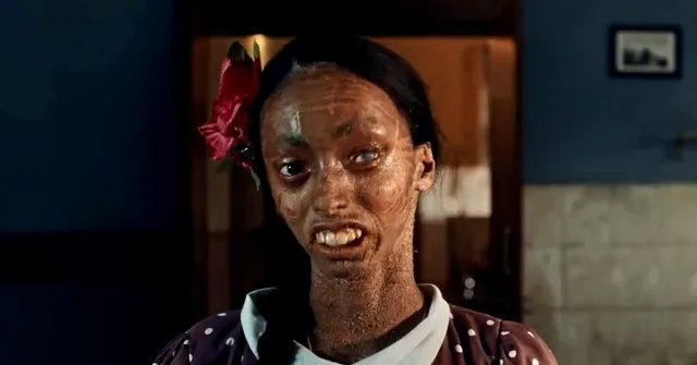 Abandoned Due to Rare Genetic Disorder, Nisha's Life Was Transformed By a Mother's Unconditional Love