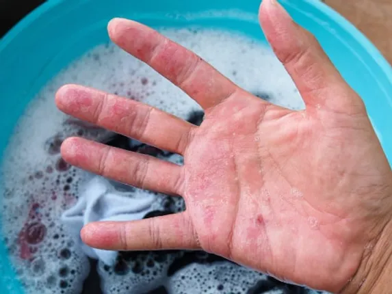 Battling Eczema? Here's How to Make Your Laundry Routine More Skin-Safe