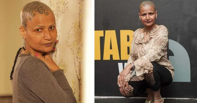 Living With Alopecia: 'I Stopped Hiding and Made My Baldness My Strength'
