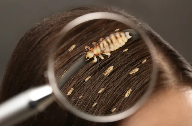 Head-lice