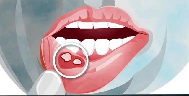 mouth-ulcers