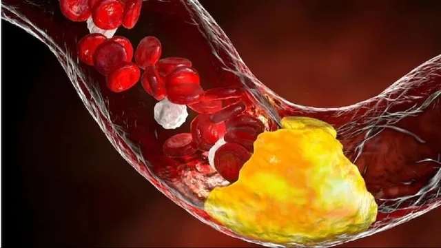Diabetes high cholesterol