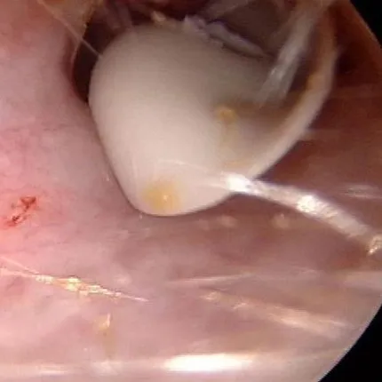 ହେଡଫୋନ ହେଲା କାଳ ! ହେଡଫୋନ ବ୍ୟବହାର କରି କାନ ହରାଇଲେ ଯୁବକ