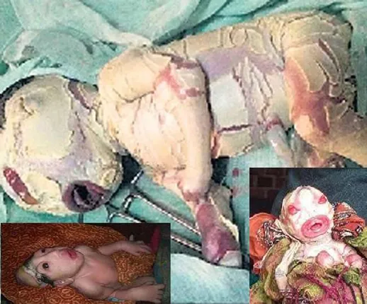 ବିହାରରେ ଏଲିୟନ ! ମାସକ ମଧ୍ୟରେ ଏଭଳି ରୂପରେ ଜନ୍ମ ହୋଇଛନ୍ତି ୩ ଶିଶୁ