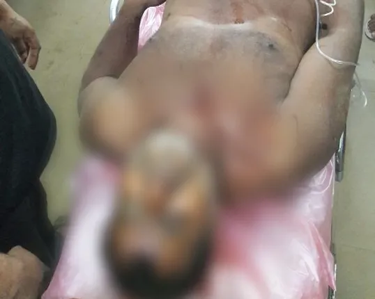 ପିପିଲି କଂଟି ଛକରେ ବୋମା ମାଡ! ଜଣେ ବ୍ୟବସାୟୀ ଗୁରୁତର