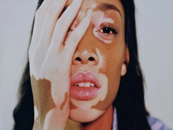 ଶରୀରରେ କାହିିଁକି ହୁଏ ଧଳାଛଉ ! ଏଥିରୁ ବଞ୍ଚିବା ପାଇଁ କିଛି ଘରୋଇ ଉପାୟ