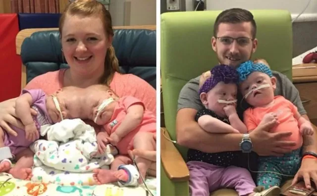 ଜଗା-ବଳିଆଙ୍କ ଭଳି ଆଉ ଏକ ଯୋଡାମୁଣ୍ଡ ଶିଶୁଙ୍କ କାହାଣୀ ! ଅପରେସନ ପରେ ସୁସ୍ଥ ହୋଇ ଘରକୁ ଫେରିଲେ, ଜଗାବଳିଆଙ୍କ ପାଇଁ ଆଶା ବଢିଲା