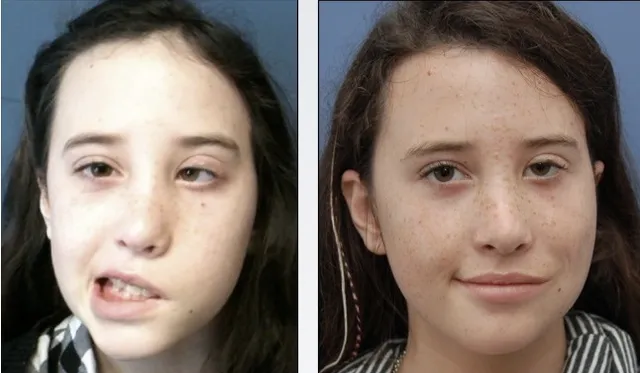 ପାରାଲିସସରୁ ତୁରନ୍ତ ବର୍ତ୍ତିବା ପାଇଁ କରନ୍ତୁ ଏହି କାମ । ବଂଚିଯିବ ରୋଗୀଙ୍କ ଜୀବନ