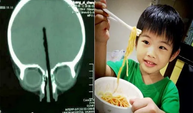 ଚପଷ୍ଟିକ୍ ମଜା ଦେଲା ସଜା ! ନାକ ଭିତରୁ ୭ ଇଞ୍ଚ୍ ମସ୍ତିଷ୍କ ଭିତରକୁ ଗଲା ଚପଷ୍ଟିକ୍ ।