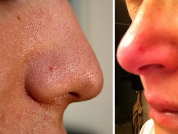 ସାବଧାନ୍ । ନାକରେ ଦେଖାଦେଉଛି କି ଏଭଳି କିଛି ପରିବର୍ତ୍ତନ, ତେବେ ଖୁବ୍ ଶୀଘ୍ର ନଷ୍ଟ ହୋଇପାରେ ଆପଣଙ୍କ କିଡନୀ, ତୁରନ୍ତ ଡାକ୍ତରଙ୍କ ପରାମର୍ଶ ନିଅନ୍ତୁ