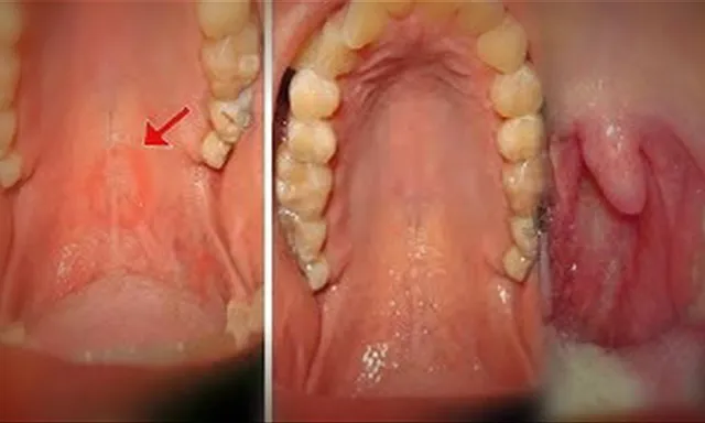 ଆପଣଙ୍କ ପାଟିରେ ଏଭଳି ଧଳାରଙ୍ଗର ଚିହ୍ନ ନାହିଁ ତ? ସାବଧାନ, ଏହା କ୍ୟାନସର ନୁହେଁ ବରଂ ତା‘ଠାରୁ ବି ବେଶି ଭୟଙ୍କର