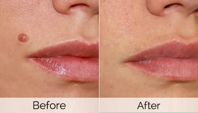 ମୁହଁରେ ଭାତୁଡି ଜନିତ ସମସ୍ୟା ଦେଖାଯାଉଛି କି ? ଆପଣାନ୍ତୁ କିଛି ସରଳ ଘରୋଇ ଉପଚାର,ସମସ୍ୟା ହେବ ଦୂର ।