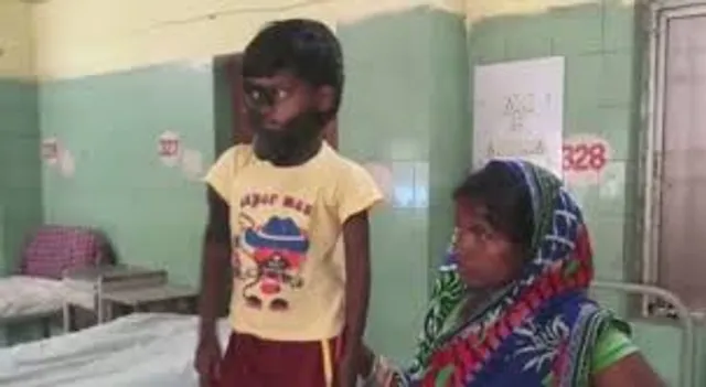 ଲୋମଶ ଶିଶୁ କାହ୍ନାର ଅସ୍ତ୍ରପୋଚାର ପରେ ମୁହଁରୁ ଖୋଲିଲା ପଟି, ସ୍ୱତନ୍ତ୍ର ଡାକ୍ତରୀ ଦଳ ରଖିଛନ୍ତି ନଜର