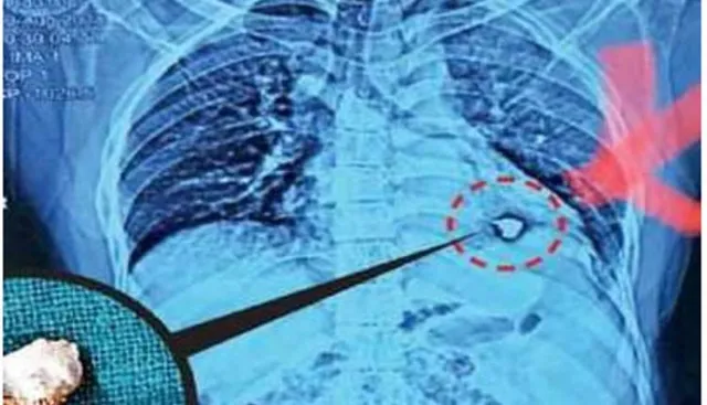 ଯୁବକଙ୍କ ହୃଦୟରୁ ବାହାରିଲା ୪ ସେଣ୍ଟିମିଟର ଲୁହାର କଣ୍ଟା ! ବିପଦ ଥିବା ଜାଣି ମଧ୍ୟ ସଫଳ ଅସ୍ତ୍ରୋପଚାର କଲେ ଡାକ୍ତର