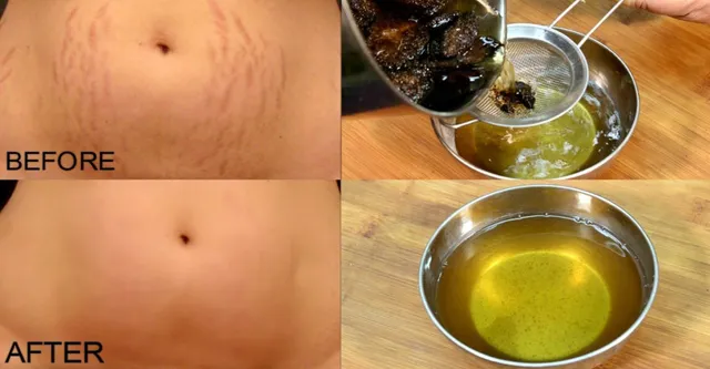 ପେଟରେ ଷ୍ଟ୍ରେଚମାର୍କ ବା ଦାଗ ପଡିଛି କି ? ଚିନ୍ତିତ ନହୋଇ ଏହାର ଉପଚାର ପାଇଁ ଜାଣନ୍ତୁ କିଛି ଆବଶ୍ୟକୀୟ ଟିପ୍ସ