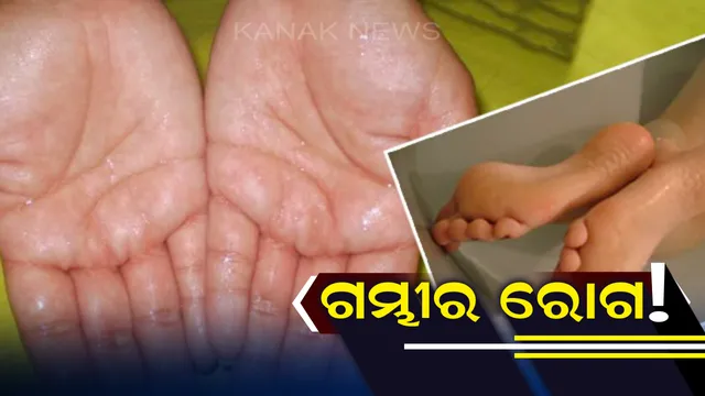 ଗରମ ନଲାଗି ମଧ୍ୟ ହାତ,ପାଦରୁ ଝାଳ ବାହାରୁଥିଲେ ସତର୍କ ହୋଇଯାଆନ୍ତୁ ! ଏହି ଗମ୍ଭୀର ରୋଗର ଶିକାର ହୋଇପାରନ୍ତି ।