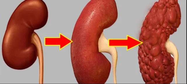 ବଜାରରେ ବିକ୍ରି ହେଉଥିବା ଏହି ୩ ଟି ଦ୍ରବ୍ୟ ହିଁ କିଡନୀ ଖରାପ ପାଇଁ ଯଥେଷ୍ଟ ! ପ୍ରତିଦିନ ଖାଉଥିବା ଲୋକ ହୋଇଯାଆନ୍ତୁ ସତର୍କ ନହେଲେ ଅକାଳରେ ଯିବ ଜୀବନ ।