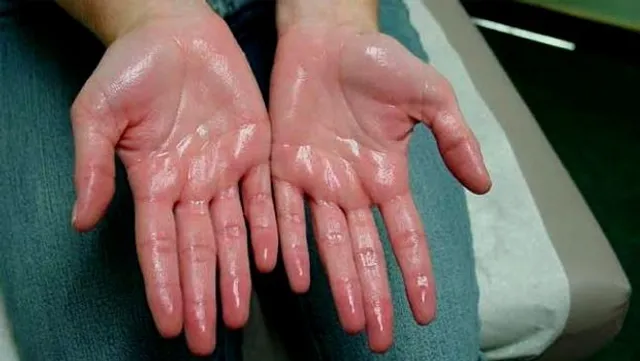 ସବୁ ଋତୁରେ ହାତ ,ପାଦ ଏବଂ ଶରୀରର ଅନ୍ୟ ଅଙ୍ଗରୁ ସାଧାରଣ ଅପେକ୍ଷା ଅଧିକ ଝାଳ ବାହାରୁଥିଲେ ସାବଧାନ ! ଆପଣଙ୍କୁ ହୋଇପାରେ ଏଭଳି ରୋଗ ।