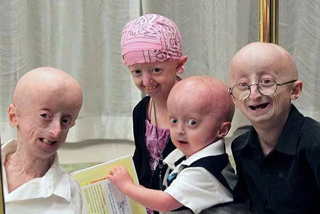 ଏଭଳି ଏକ ରୋଗ ଯେଉଁଥିରେ ଶିଶୁ ଦେଖାଯାନ୍ତି ବୃଦ୍ଧ ! କ’ଣ ଏହି ରୋଗ ଆସନ୍ତୁ ଜାଣିବା । 