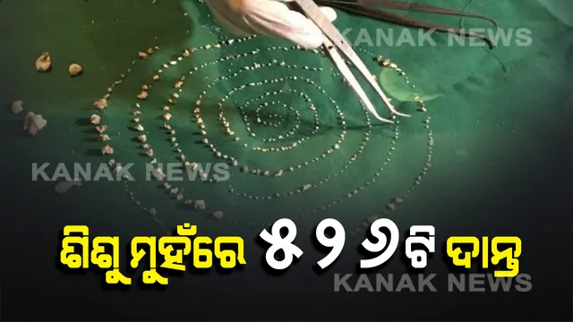 ୭ ବର୍ଷର ଶିଶୁ ମୁହଁରେ ୫୨୬ଟି ଦାନ୍ତ ! ଡାକ୍ତର ମଧ୍ୟ ହୋଇଗଲେ ଆଶ୍ଚର୍ଯ୍ୟ, ଦୀର୍ଘ ୫ ଘଂଟାର ବିରଳ ଅସ୍ତ୍ରୋପଚାର ପରେ ବାହାରିଲା ଅତିରିକ୍ତ ଦାନ୍ତ ।