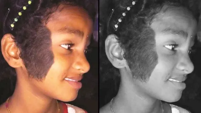 କିଏ ଶୁଣିବ ପୂଜାରାଣୀର ଦୁଃଖ ? ମୁହଁରେ ମାଡ଼ି ଚାଲିଛି କଳା ଲୋମ, ଅର୍ଥଅଭାବରୁ ହୋଇପାରୁନି ଚିକିତ୍ସା