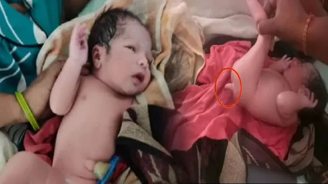 ଲାଞ୍ଜ ସହ ଜନ୍ମନେଲା ଶିଶୁ ! ନବଜାତକୁ ଦେଖିବା ପାଇଁ ହସ୍ପିଟାଲରେ ଲାଗିଲା ଭିଡ଼ ।