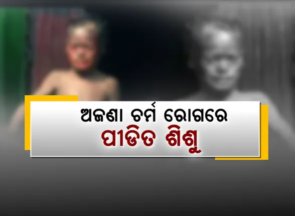 ଯନ୍ତ୍ରଣାରେ ଜଡ଼ସଡ଼ କୁନି ପୁଅର ଜୀବନ। ଅଜଣା ଚର୍ମରୋଗରେ ପୀଡିତ ଶେରଗଡ ଗୋଠଗାଁ ଦାଣ୍ଡର ୧୦ ବର୍ଷର ଜଗନ୍ନାଥ। ଚିକିତ୍ସା ପାଇଁ ଅର୍ଥ ସାଜିଛି ବାଧକ । କୁନି ପୁଅଟିକୁ ଯିଏ ଦେଖୁଛି, ସିଏ କହୁଛି ହେ ଜଗନ୍ନାଥ! ଜଗାକୁ ସାହା ହୁଅ...