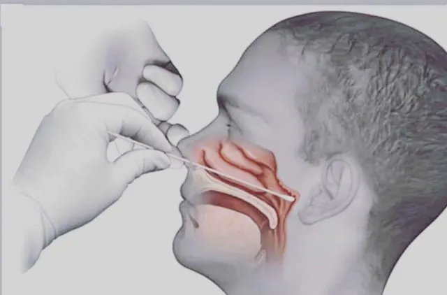 ୬ବର୍ଷର କୁନି ପିଲା ପାଇଁ କୋଭିଡ୍ ପରୀକ୍ଷା ହେଲା କାଳ... ଆଣ୍ଟିଜେନ୍ ଟେଷ୍ଟ ବେଳେ ଖାଦ୍ୟନଳୀରେ ପଶିଗଲା କିଟ୍...