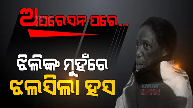 ଝିଲିଙ୍କ ମୁହଁରେ ଝଲସୁଛି ହସ... ଅପରେସନ ଆଣିଦେଲା ନୂଆ ଆଶା, ଦେଖାଇଲା ବଞ୍ଚିବାର ବାଟ । ନିଆଁରେ ପୋଡିଯାଇଥିଲା ପୂରା ଶରୀର