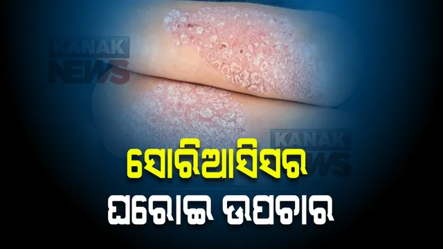 ଶୀତଦିନେ କଷ୍ଟ ଦେଉଛି ସୋରିଆସିସ । ଜାଣନ୍ତୁ ଏହାର ଘରୋଇ ଉପଚାର