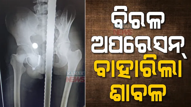 ଏମକେସିଜି ମେଡିକାଲରେ ବିରଳ ଅସ୍ତ୍ରୋପଚାର : ୫ ଘଣ୍ଟାର ଅପରେସନ୍ ପରେ ମଳଦ୍ୱାରରୁ ବାହାରିଲା ଶାବଳ
