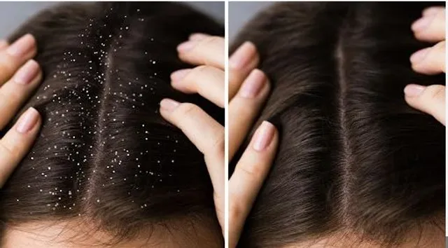 ରୁପି ସମସ୍ୟା : ଏହା ପଛର କାରଣ କ’ଣ ଓ ଏହାକୁ କିପରି ନିୟନ୍ତ୍ରଣରେ ରଖିହେବ ?