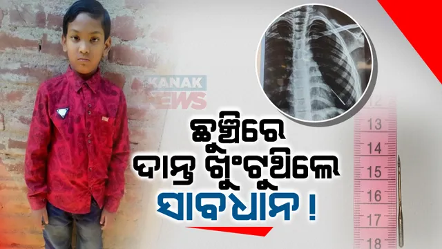 ଦାନ୍ତ ଖୁଣ୍ଟୁଥିବା ବେଳେ ଗିଳିଦେଲେ ଛୁଞ୍ଚି, ବିନା ଅସ୍ତ୍ରୋପଚାରରେ ୯ ବର୍ଷର ଶିଶୁଙ୍କ ଜୀବନ ବଞ୍ଚାଥଲେ ଭୁବନେଶ୍ୱର ଏମ୍ସର ଡାକ୍ତର ।