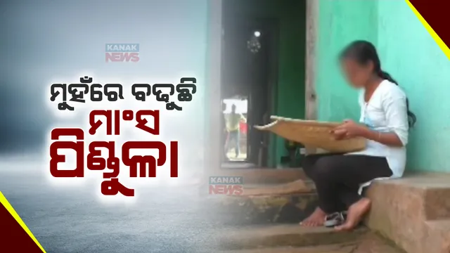 ଯନ୍ତ୍ରଣାରେ ଜର୍ଜରିତ ଜୀବନ । ଯୁବତୀଙ୍କ ମୁହଁରେ ବଢୁଛି ମାଂସ ପିଣ୍ଡୁଳା, ଚିକିତ୍ସାରେ ଅର୍ଥ ସାଜିଛି ବାଧକ