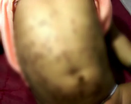 Yet another infant branded in Odisha, hospitalized