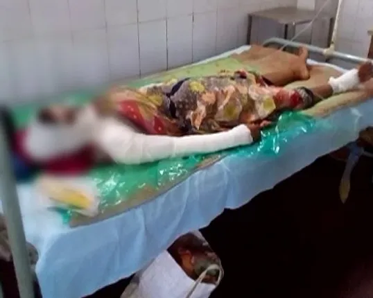 Man throws acid on estranged wife in Odisha’s Dhenkanal