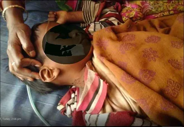 3-yr-old branded with hot iron in Odisha’s Keonjhar
