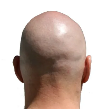 Know why you turn bald