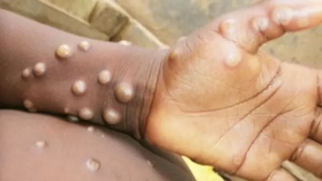 Closely monitoring monkeypox situation, no new reported cases in India: Centre