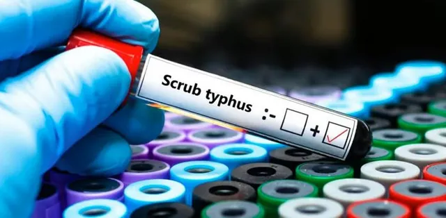 scrub typhus 