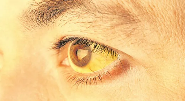 ମାଳି କଲୋନିରେ ଜଣ୍ଡିସ୍‌ ଆତଙ୍କ